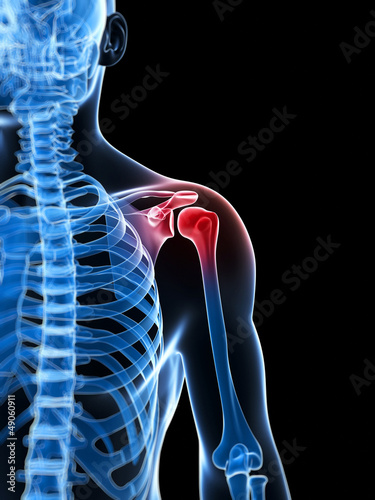Illustration: 3d rendered illustration of a painful shoulder 3d rendered illustration of a painful shoulder