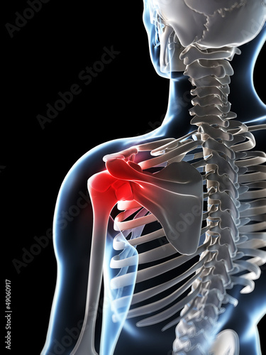 Illustration: 3d rendered illustration of a painful shoulder 3d rendered illustration of a painful shoulder