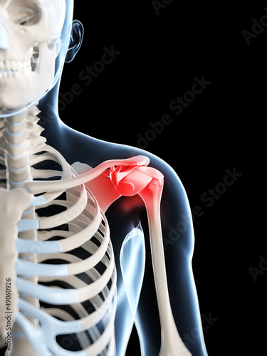 Illustration: 3d rendered illustration of a painful shoulder 3d rendered illustration of a painful shoulder