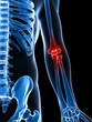 3d rendered illustration of a painful elbow