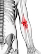 3d rendered illustration of a painful elbow