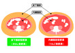 内臓脂肪と皮下脂肪の断面図
