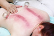 fire cupping treatment to cup sb therapy woman