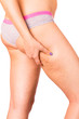 Photo: Skin staggered a cellulite Skin staggered a cellulite