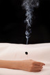 Burning acupuncture needle