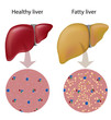 Fatty liver, eps10