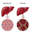 Liver Cirrhosis, eps10