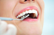 Close-up of young female having her teeth examinated