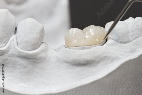 Photo: dental onlay on a cast model dental onlay on a cast model