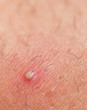 ingrown hair