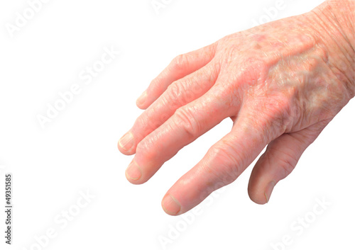 Photo: Womans hand showing the deforimity of arthritis isolated Womans hand showing the deforimity of arthritis isolated