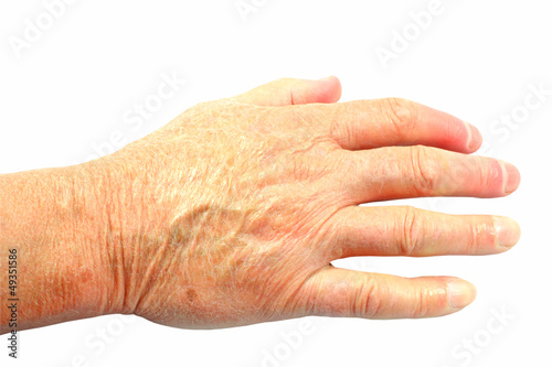 Photo: Back of mans hand showing very dry skin isolated Back of mans hand showing very dry skin isolated