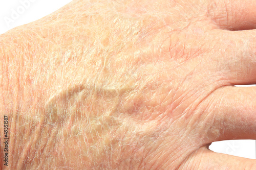 Photo: Close up of the back of a mans hand showing very dry skin Close up of the back of a mans hand showing very dry skin