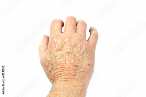 Photo: Back of mans hand showing very dry skin isolated Back of mans hand showing very dry skin isolated