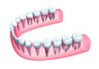 Human jaw model with teeth and implant.