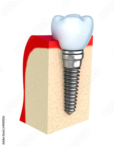 Illustration: Dental implant in jaw bone Dental implant in jaw bone