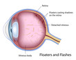 Floaters and Flashes, eps10
