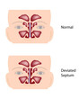 Deviated nasal septum, eps10