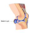 Baker's cyst, eps8