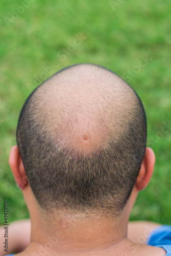 Photo: A crater in the middle of the head A crater in the middle of the head