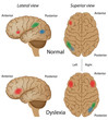 Dyslexia brain activity, eps10