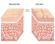 Vector: Dry skin, eps8 Dry skin, eps8