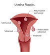 Uterine fibroid, eps8