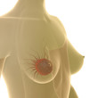 Illustration: breast cancer - 3D Render breast cancer - 3D Render