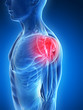 3d rendered illustration - painful shoulder muscles