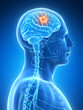3d rendered illustration - brain tumor