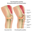 Knie Krankheit Chondropathia patellae
