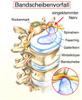 Illustration: Bandscheibenvorfall.Eingeklemmter Nerv Bandscheibenvorfall.Eingeklemmter Nerv
