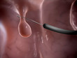 3d rendered illustration of a polyp removal