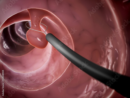 Illustration: 3d rendered illustration of a polyp removal 3d rendered illustration of a polyp removal