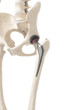3d rendered illustration of a hip replacement