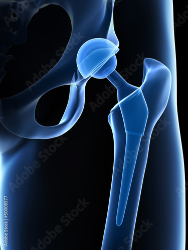 Illustration: 3d rendered illustration of a hip replacement 3d rendered illustration of a hip replacement