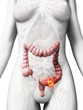 3d rendered illustration of colon cancer