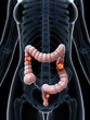 3d rendered illustration of colon cancer
