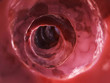 inside of an unhealthy colon