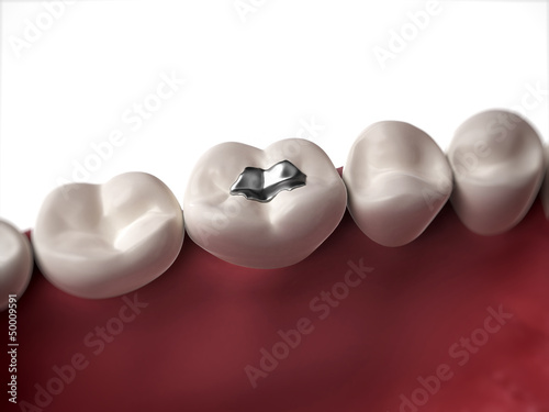 Illustration: 3d rendered illustration of an amalgam filling 3d rendered illustration of an amalgam filling