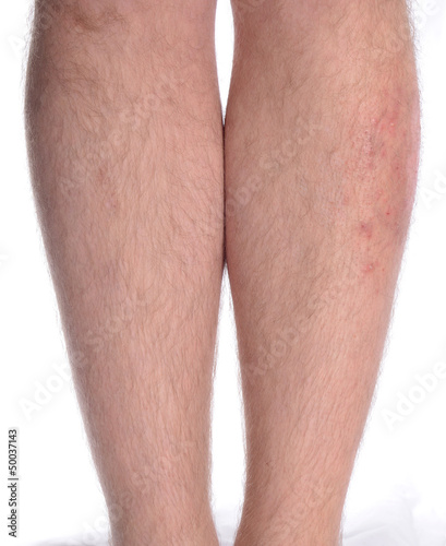Photo: Skin Disease on the Leg Skin Disease on the Leg