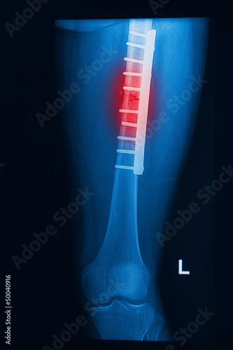 Photo: X- Rays image broken knee joint with plate and screw X- Rays image broken knee joint with plate and screw