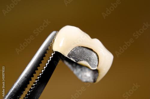 Photo: Abplatzung an Keramik-Krone Abplatzung an Keramik-Krone