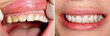 Before and after treatment