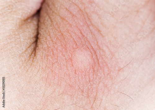 Photo: Mosquito bite on human hand, macro photo Mosquito bite on human hand, macro photo