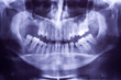 Buccal x-ray