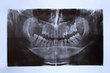teeth x-ray