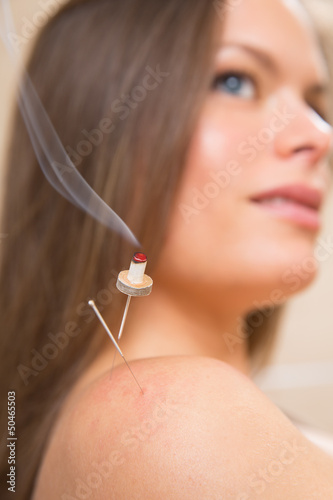 Photo: moxibustion acupunture needles heat on woman moxibustion acupunture needles heat on woman