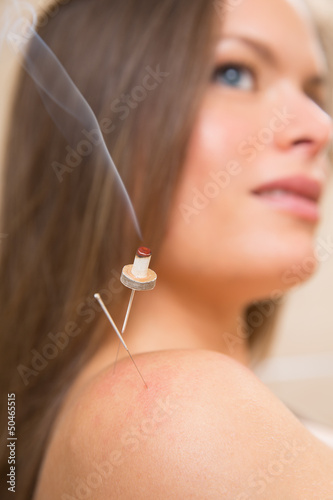 Photo: moxibustion acupunture needles heat on woman moxibustion acupunture needles heat on woman