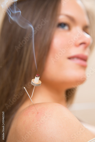 Photo: moxibustion acupunture needles heat on woman moxibustion acupunture needles heat on woman